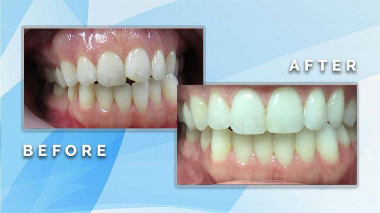 Before and after comparison showing cosmetic repair and alignment of irregular front teeth into a smooth, bright smile