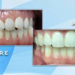 Before and after comparison showing cosmetic repair and alignment of irregular front teeth into a smooth, bright smile