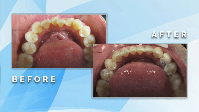 Before and after occlusal view demonstrating orthodontic straightening and arch alignment of crowded lower teeth.