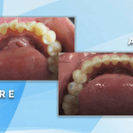 Before and after occlusal view demonstrating orthodontic straightening and arch alignment of crowded lower teeth.