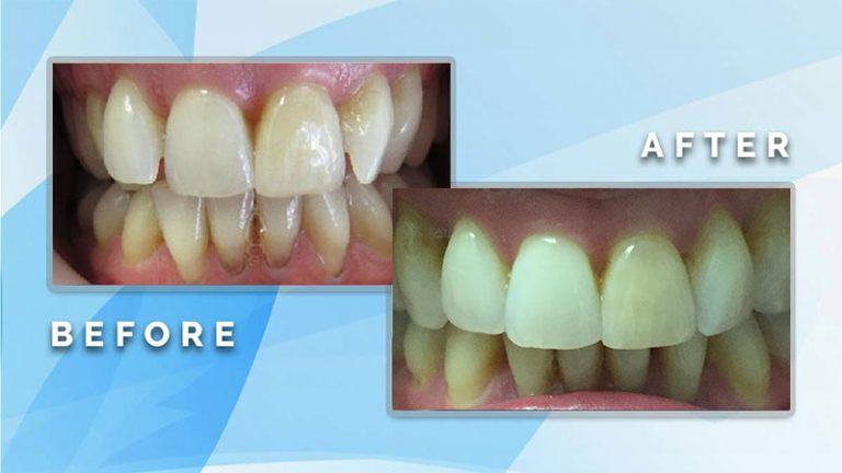 Before and after comparison displaying closure of gaps and reshaping between lower front teeth.