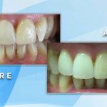 Before and after comparison displaying closure of gaps and reshaping between lower front teeth.