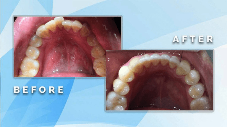Before and after occlusal view showing orthodontic correction and realignment of severely crowded upper teeth.