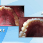 Before and after occlusal view showing orthodontic correction and realignment of severely crowded upper teeth.