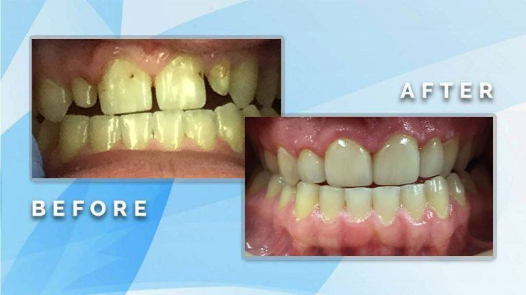 Before and after dental restoration comparison showing closure of gaps and alignment of misaligned teeth.