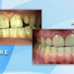 Before and after dental restoration comparison showing closure of gaps and alignment of misaligned teeth.