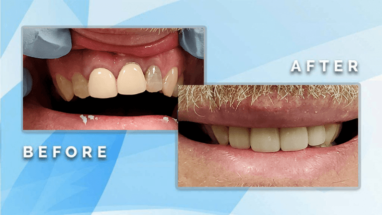 Before and after cosmetic dental treatment showing replacement of a discolored front tooth with a natural-looking restoration.