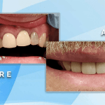 Before and after cosmetic dental treatment showing replacement of a discolored front tooth with a natural-looking restoration.