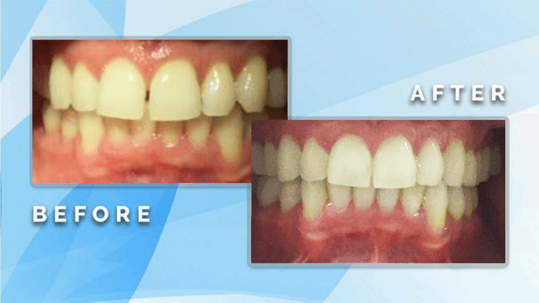 Before and after comparison demonstrating gap closure and symmetrical restoration of upper front teeth.