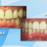 Before and after comparison demonstrating gap closure and symmetrical restoration of upper front teeth.