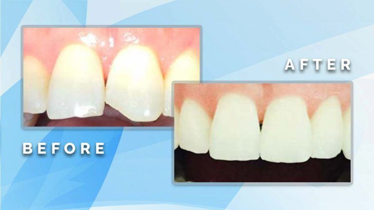 Before and after comparison showing cosmetic repair and restoration of a chipped upper front central incisor.