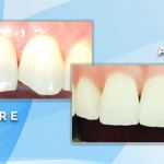 Before and after comparison showing cosmetic repair and restoration of a chipped upper front central incisor.