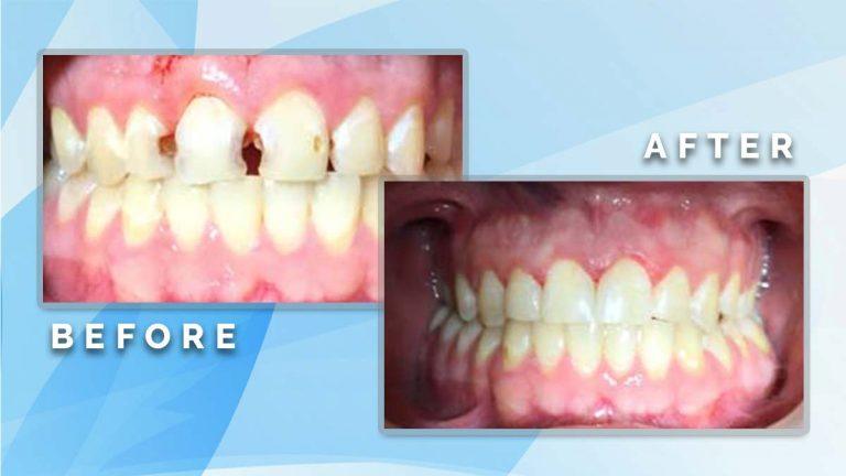 Before and after comparison showing restorative treatment to fill prominent gaps and decay between front teeth.