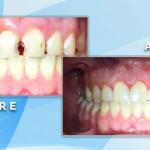 Before and after comparison showing restorative treatment to fill prominent gaps and decay between front teeth.