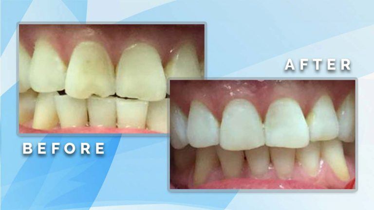 Before and after comparison showing cosmetic restoration and smoothing of chipped upper front teeth edges.