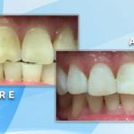 Before and after comparison showing cosmetic restoration and smoothing of chipped upper front teeth edges.