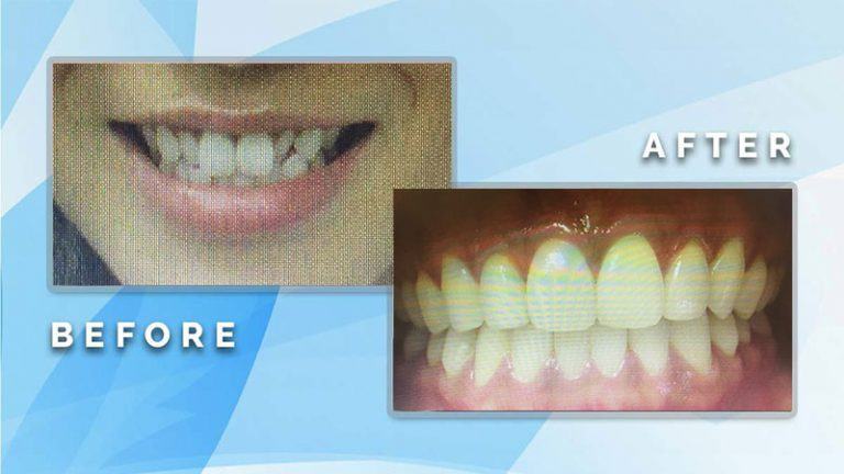 Before and after smile comparison showing orthodontic correction and alignment of crowded upper front teeth.