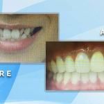 Before and after smile comparison showing orthodontic correction and alignment of crowded upper front teeth.