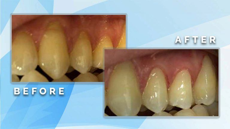 Before and after comparison demonstrating periodontal gum line treatment and restoration near the tooth roots.