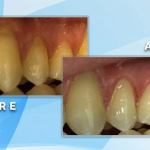 Before and after comparison demonstrating periodontal gum line treatment and restoration near the tooth roots.