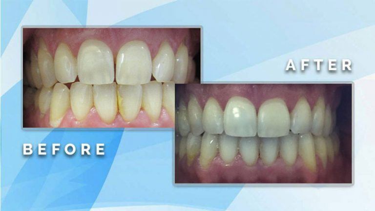 Before and after comparison showing shade enhancement and restoration of yellowed, uneven teeth to a clean, white appearance.
