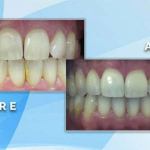 Before and after comparison showing shade enhancement and restoration of yellowed, uneven teeth to a clean, white appearance.