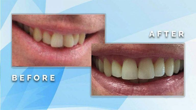 Before and after close-up comparison showing shape improvement and shade brightening of upper front teeth.