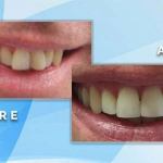 Before and after close-up comparison showing shape improvement and shade brightening of upper front teeth.