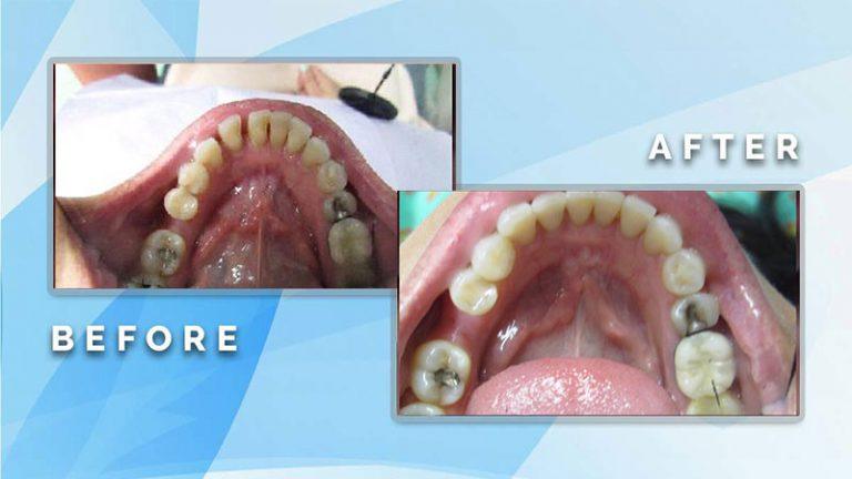 Before and after occlusal view showing deep cleaning and restoration of lower teeth and dental restorations.