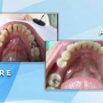 Before and after occlusal view showing deep cleaning and restoration of lower teeth and dental restorations.