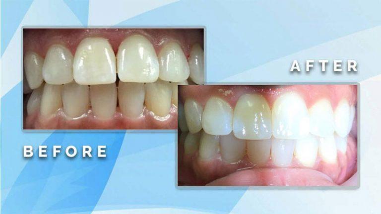 Before and after comparison displaying full-mouth teeth whitening and cosmetic shade enhancement.