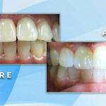 Before and after comparison displaying full-mouth teeth whitening and cosmetic shade enhancement.