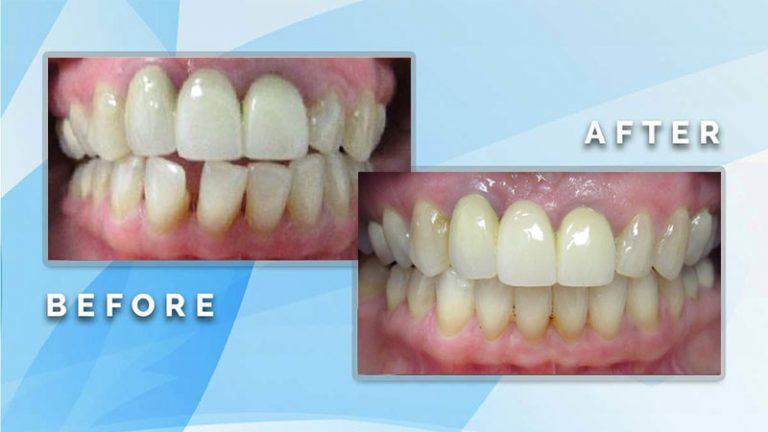 Before and after comparison showing repair of uneven lower front teeth and overall smile alignment.