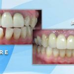 Before and after comparison showing repair of uneven lower front teeth and overall smile alignment.