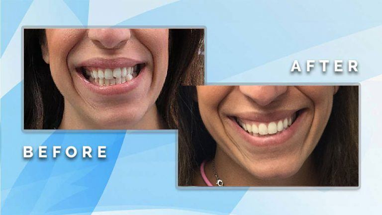 Before and after smile comparison demonstrating alignment correction and aesthetic restoration of a patient's front teeth.