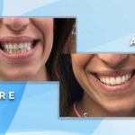 Before and after smile comparison demonstrating alignment correction and aesthetic restoration of a patient's front teeth.