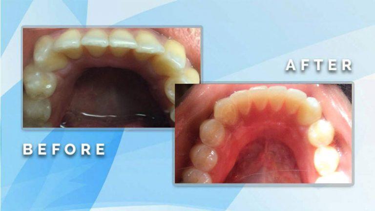 Before and after occlusal view showing alignment and straightening of crowded lower front teeth.