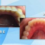 Before and after occlusal view showing alignment and straightening of crowded lower front teeth.